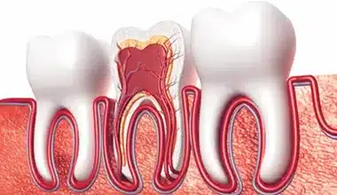 Root Canal Diagram